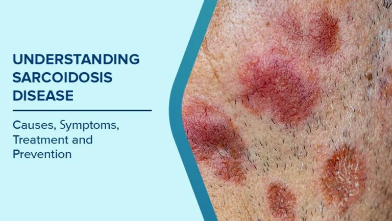 SARCOIDOSIS