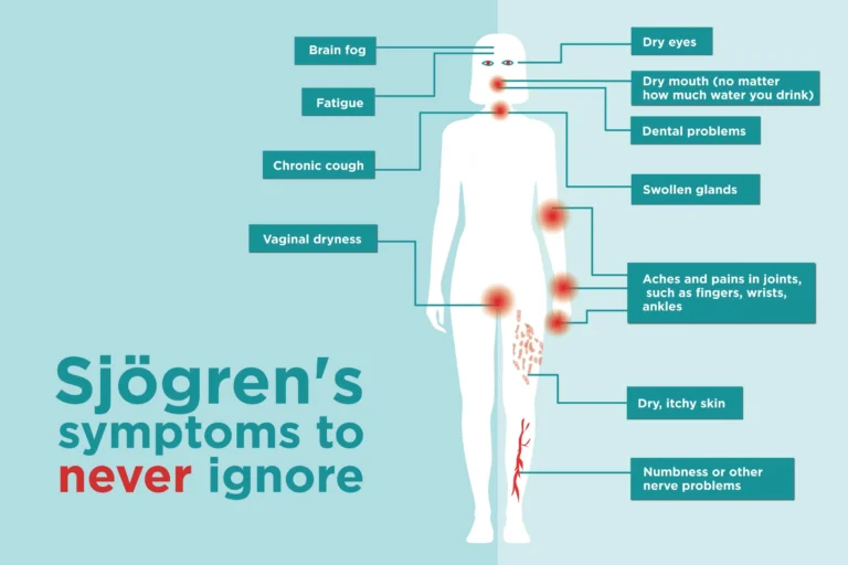 SJOGREN'S SYNDROME