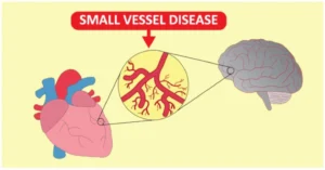 SMALL VESSEL DISEASE