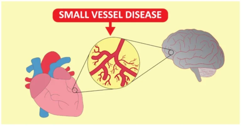 SMALL VESSEL DISEASE
