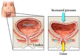 STRESS INCONTINENCE