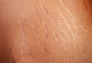Stretch marks