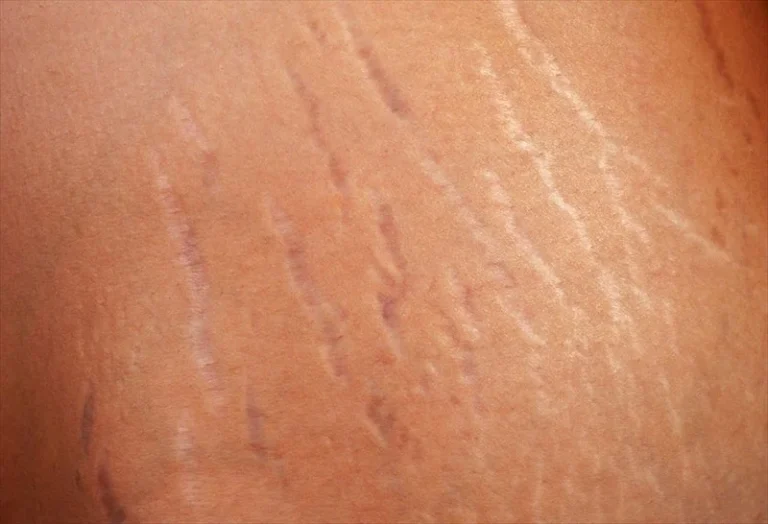 Stretch marks