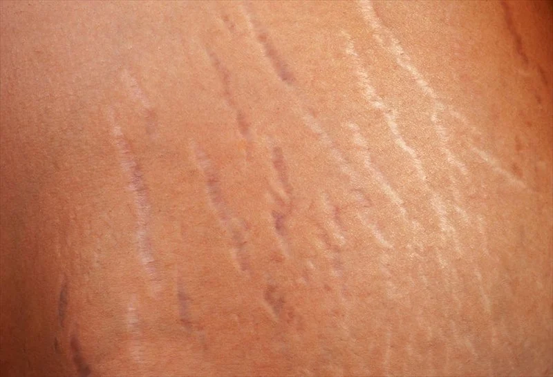 Stretch marks