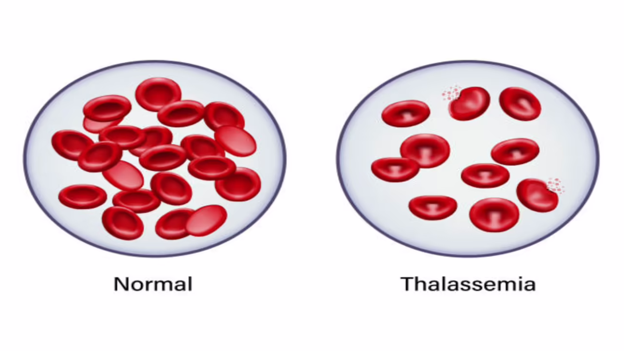THALASSEMIA