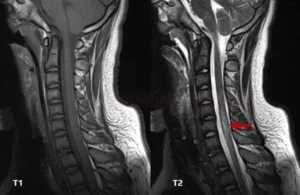 TRANSVERSE MYELITIS