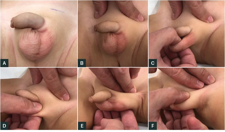 UNDESCENDED TESTICLE