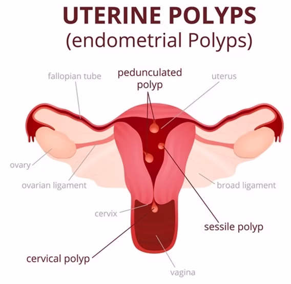 UTERINE POLYPS