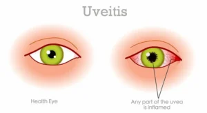 UVEITIS