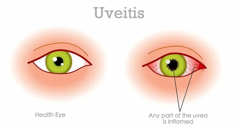 UVEITIS