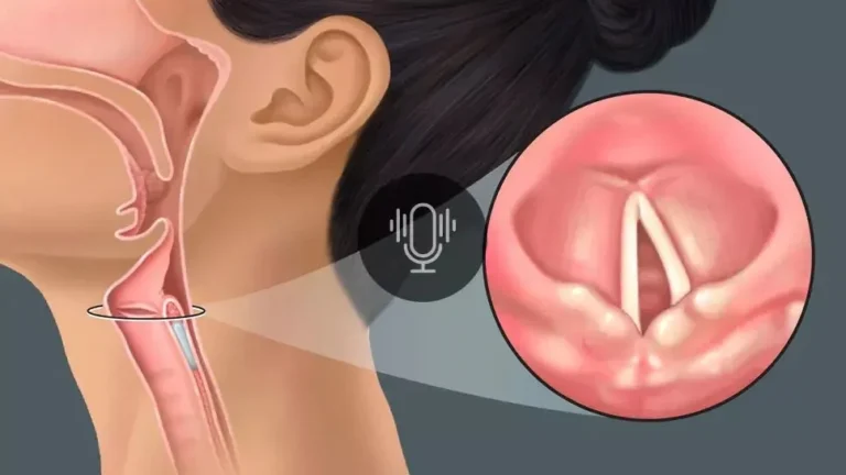 VOCAL CORD PARALYSIS