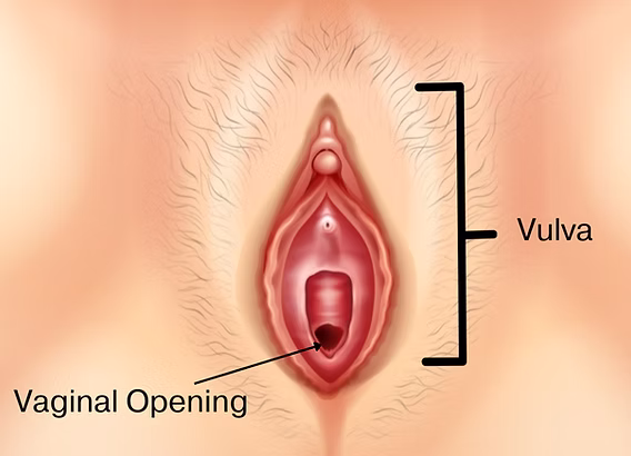 VULVODYNIA
