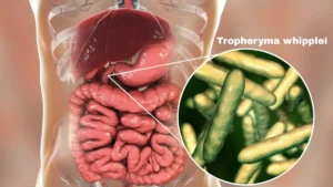 WHIPPLE'S DISEASE