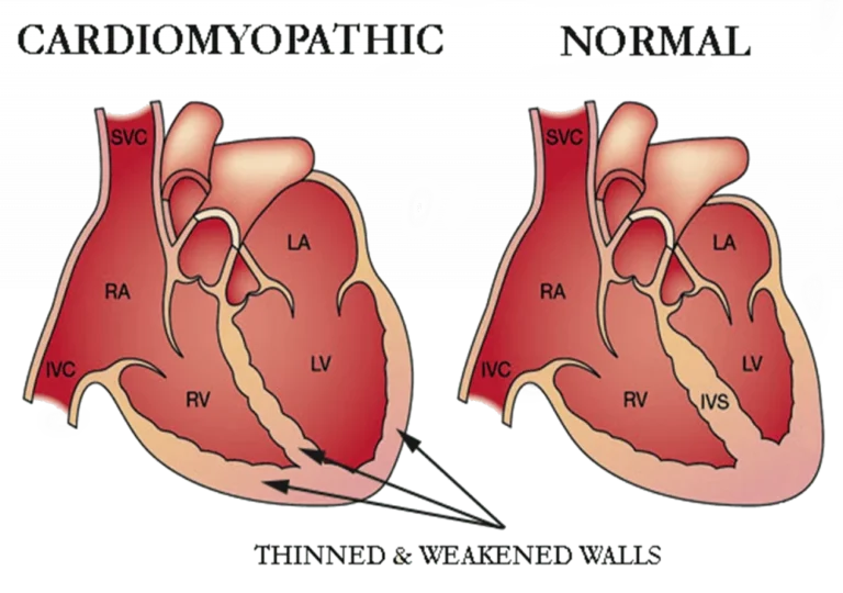 CARDIOMYOPATHY