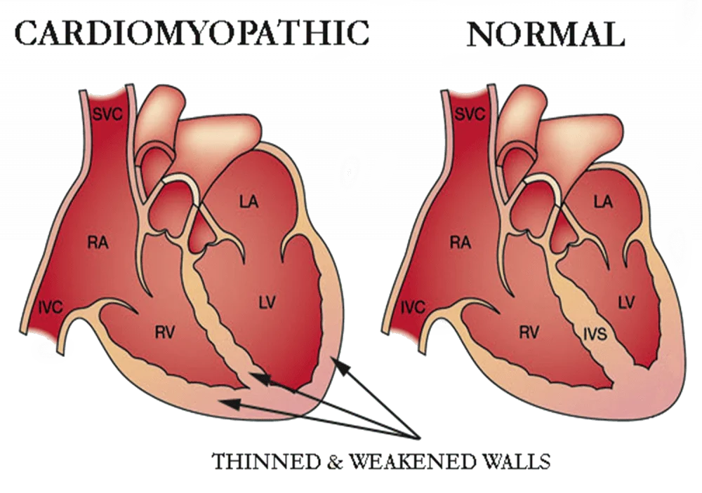 CARDIOMYOPATHY