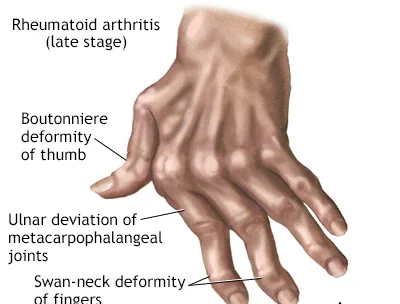 COLLAGEN VASCULAR DISEASE