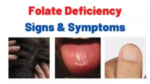 FOLATE DEFICIENCY