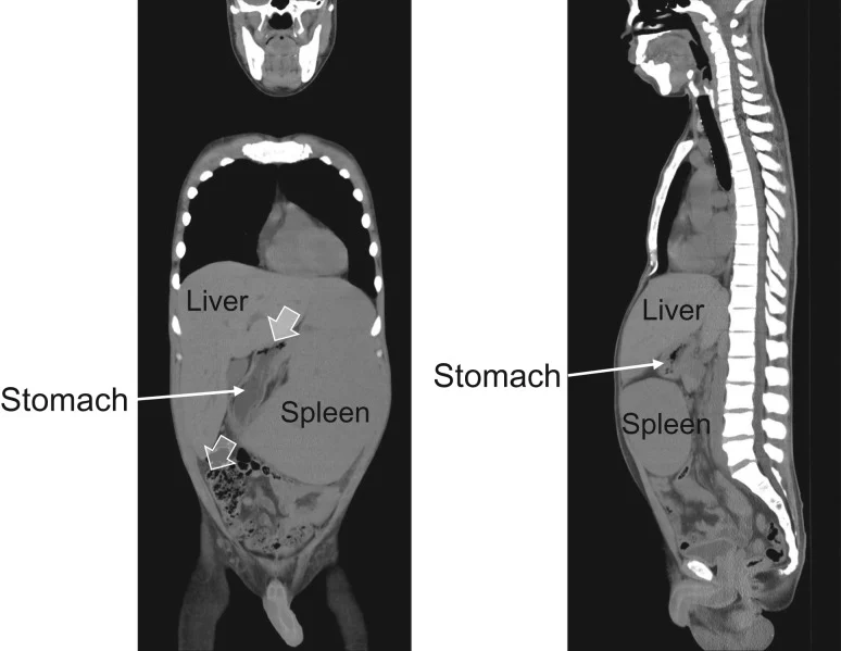 HEPATOSPLENOMEGALY
