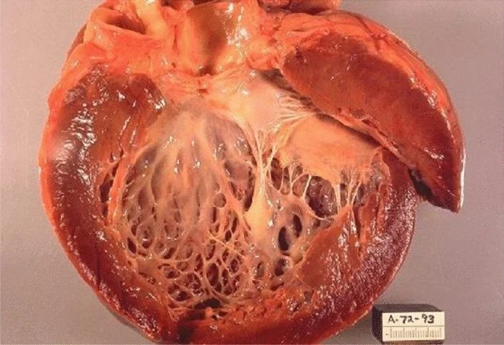 KESHAN DISEASE