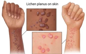 LICHEN PLANUS