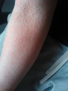 SOLAR URTICARIA