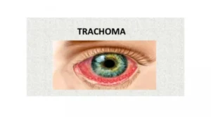 TRACHOMA