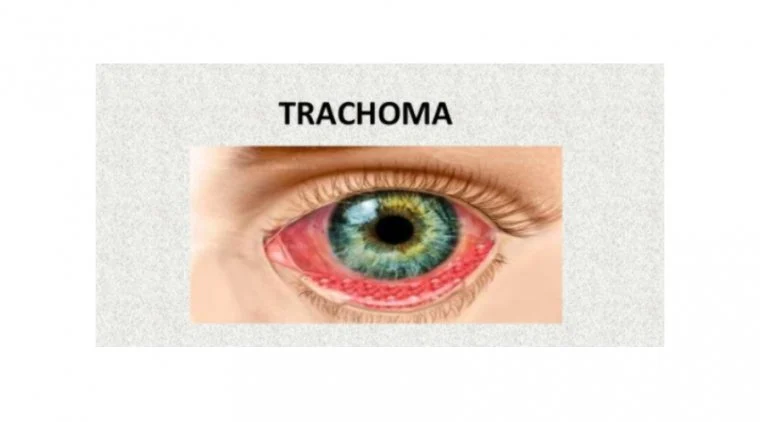 TRACHOMA