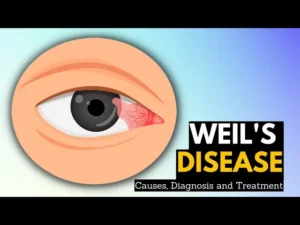 WEIL'S DISEASE
