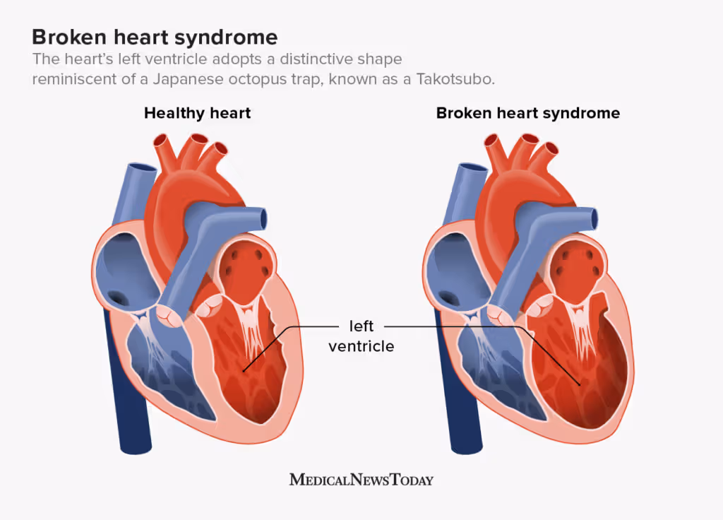 Broken Heart