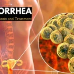 Gonorrhea