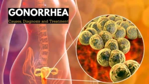 Gonorrhea