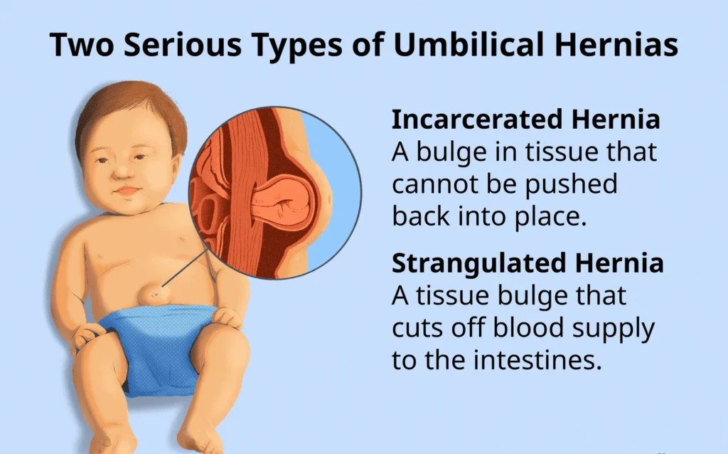Umbilical Hernia