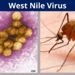 West Nile Virus