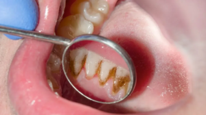 gum disease exposed