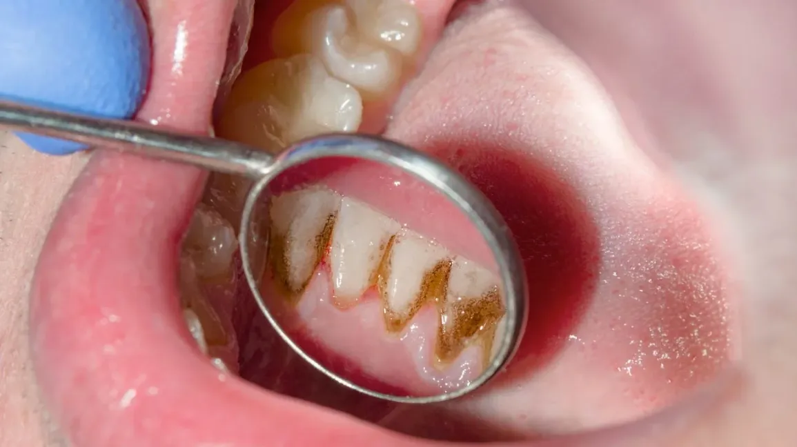 gum disease exposed