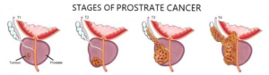 prostate cancer stages