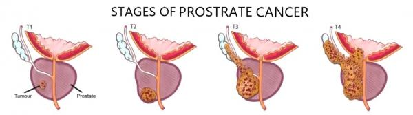 prostate cancer stages