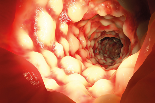 Crohn’s Disease