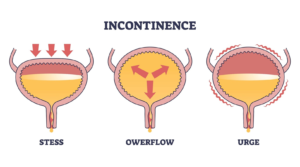 urinary incontinence