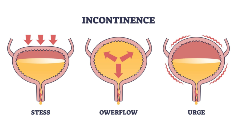 urinary incontinence