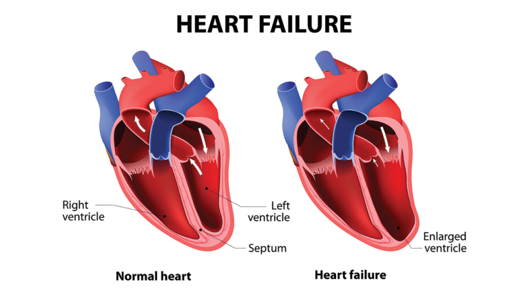 Heart Failure