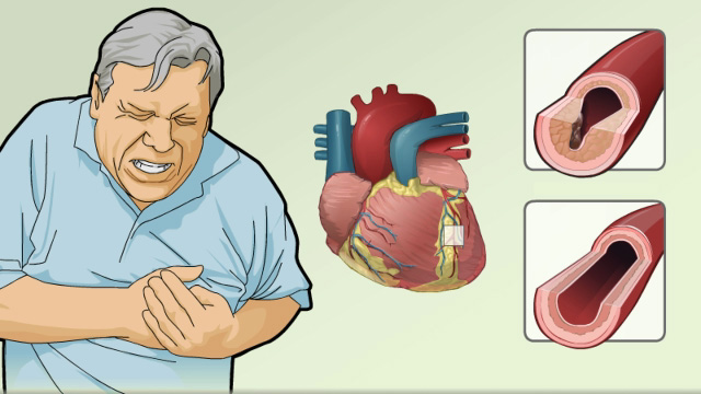 Angina