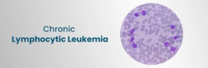 Chronic Lymphocytic Leukemia