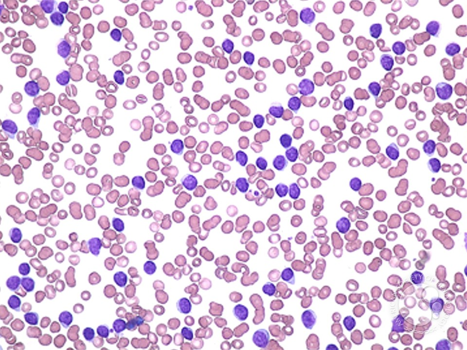 Chronic Lymphocytic Leukemia