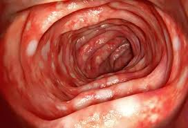 Colitis