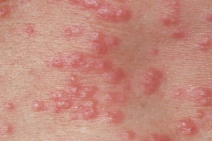 Scabies outbreak