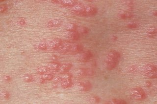Scabies outbreak