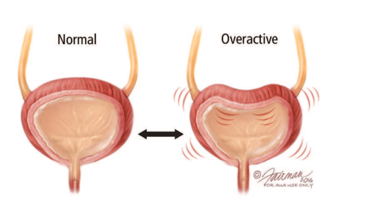 Overactive Bladder