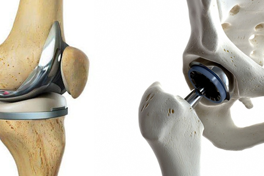 joint replacement