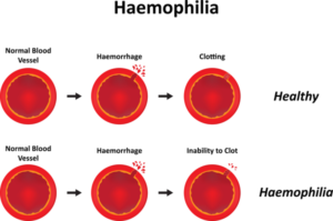 hemophilia